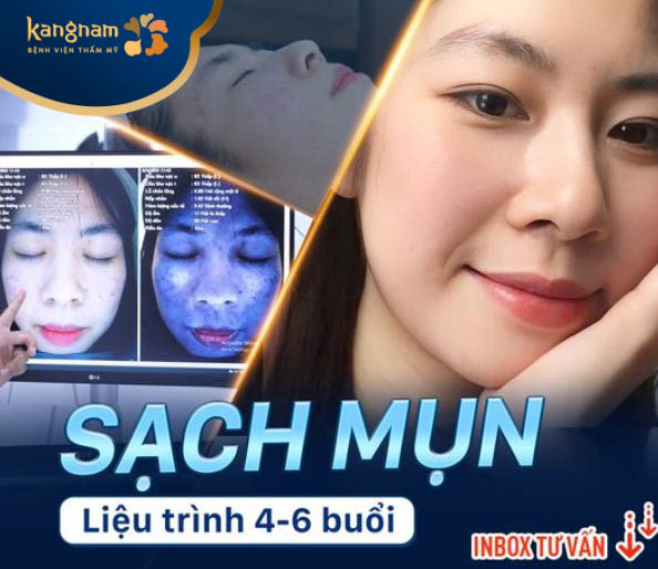 Dịch vụ điều trị mụn tại Kangnam Đà Nẵng