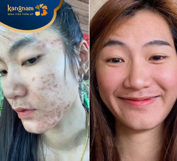 Bạn Thùy Linh chia sẻ hình ảnh về hành trình trị mụn của mình