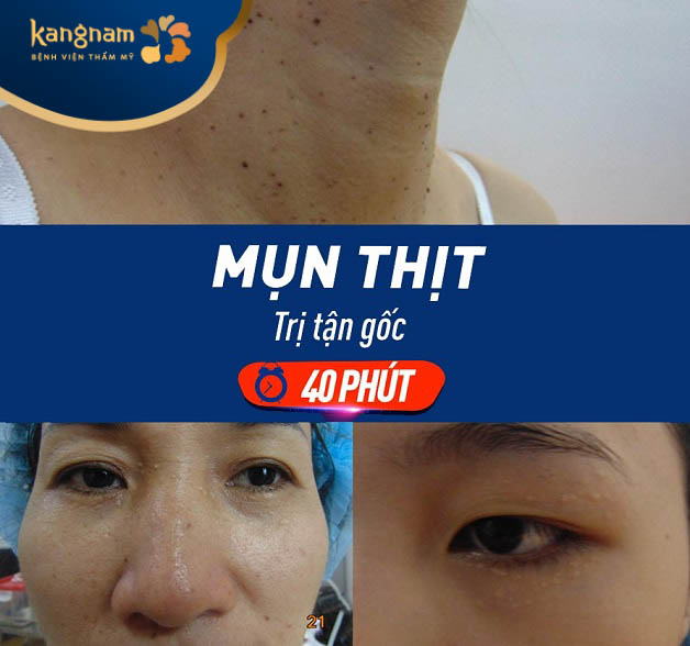 Laser trị mụn thịt
