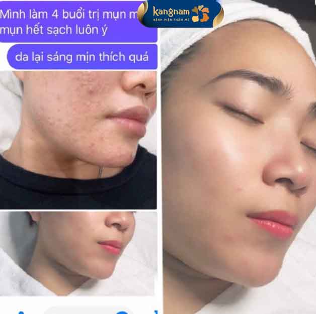 Bạn Thu Trang chia sẻ sau trị mụn tại Kangnam Hải Phòng