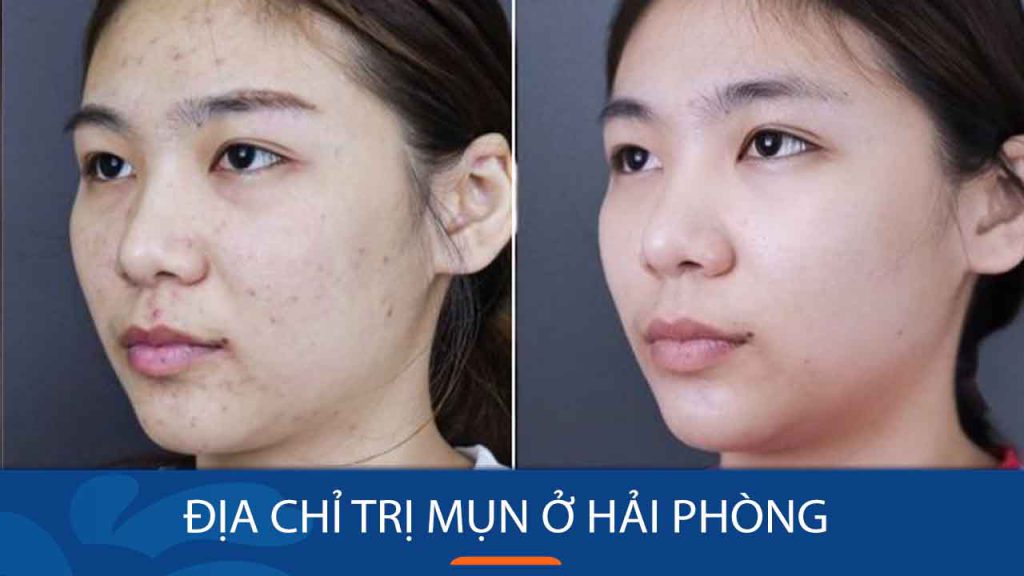 Địa chỉ trị mụn ở Hải Phòng đất cảng Uy Tín Nhất