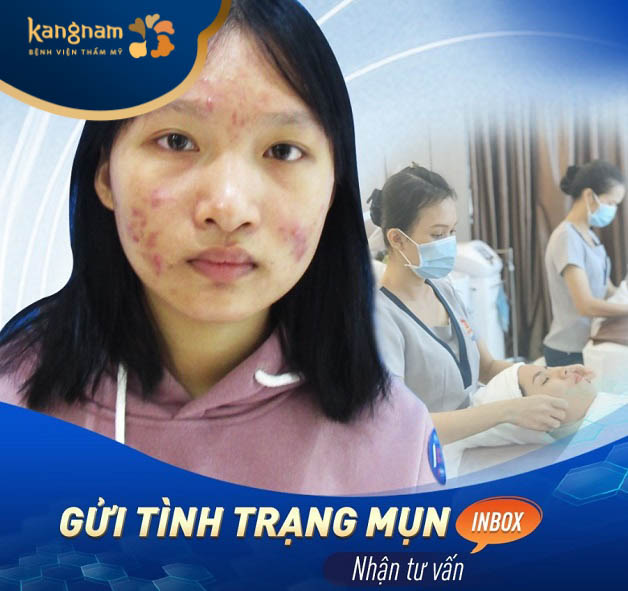 trị mụn tại Viện thẩm mỹ Kangnam Hải Phòng
