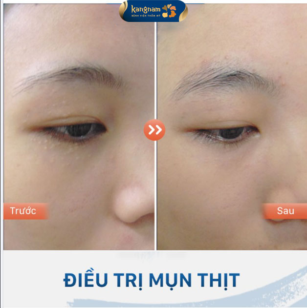 Laser trị mụn thịt tại Kangnam 
