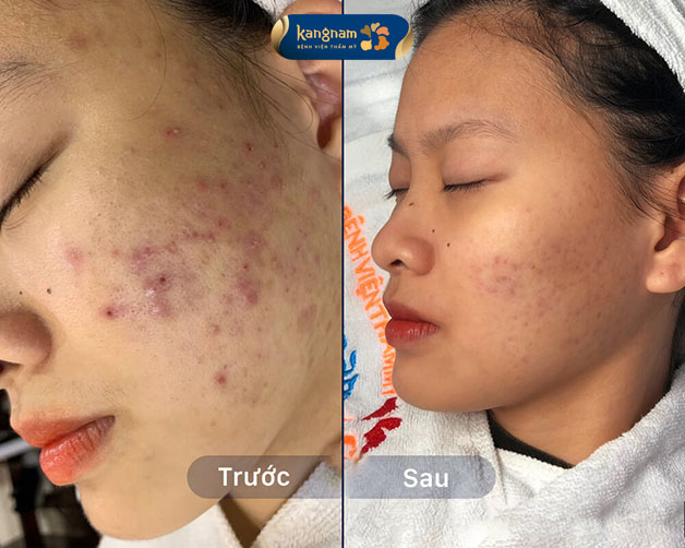 Tình trạng mụn viêm, mụn ẩn trên da giảm hẳn sau 5 buổi điều trị 