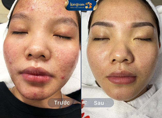 Hình ảnh khách hàng sau khi điều trị 4 buổi tại Kangnam 