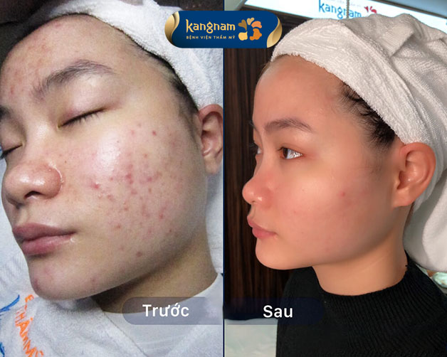 Làn da láng mịn, không còn mụn thâm sau 1 liệu trình 
