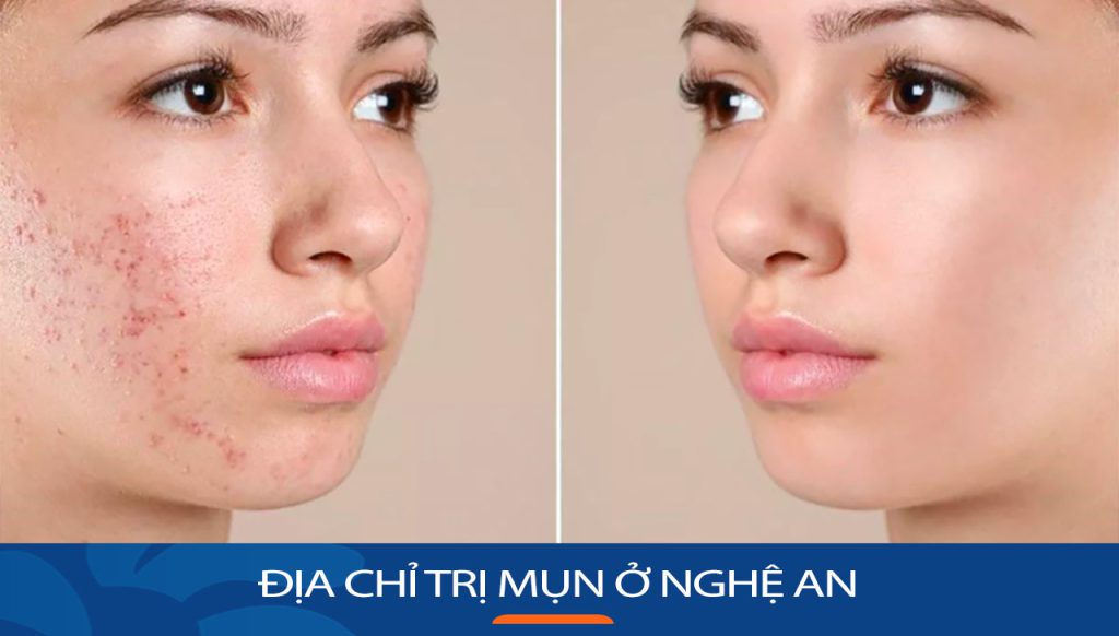 Viện thẩm mỹ Kangnam – Địa chỉ trị mụn ở Nghệ An uy tín