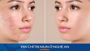 Viện thẩm mỹ Kangnam – Địa chỉ trị mụn ở Nghệ An uy tín