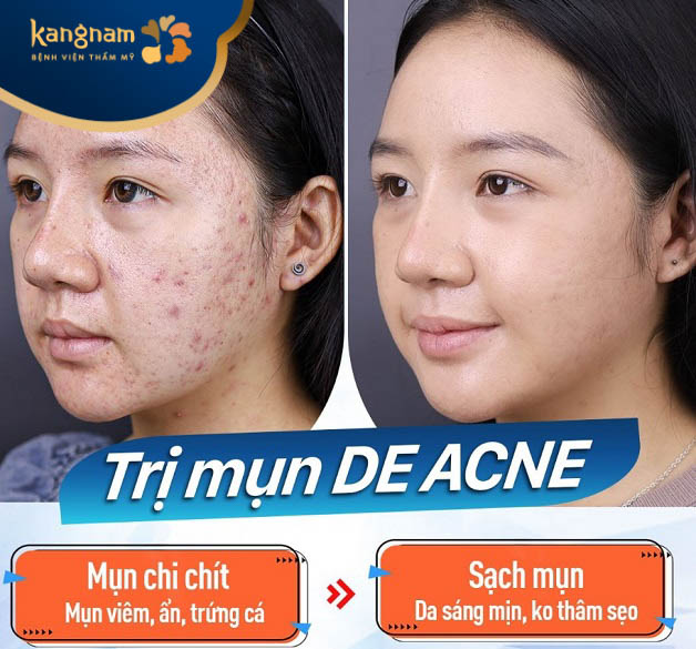 Trị mụn De-Acne tân tiến tại Kangnam