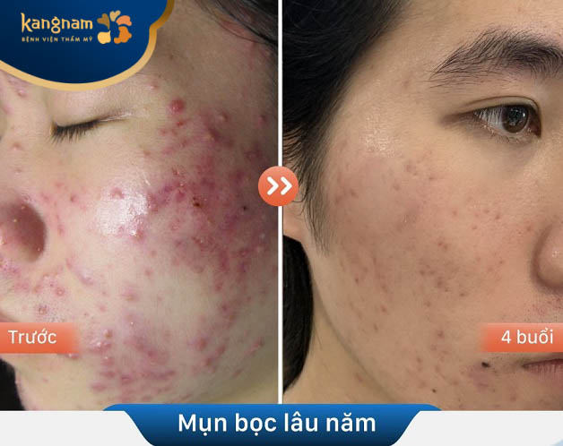 Mụn bọc lâu năm được điều trị khỏi tại Kangnam