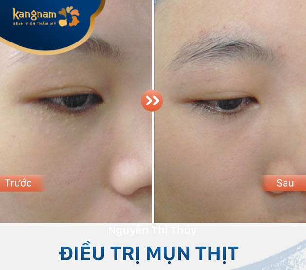 Điều trị mụn thịt hiệu quả bằng laser