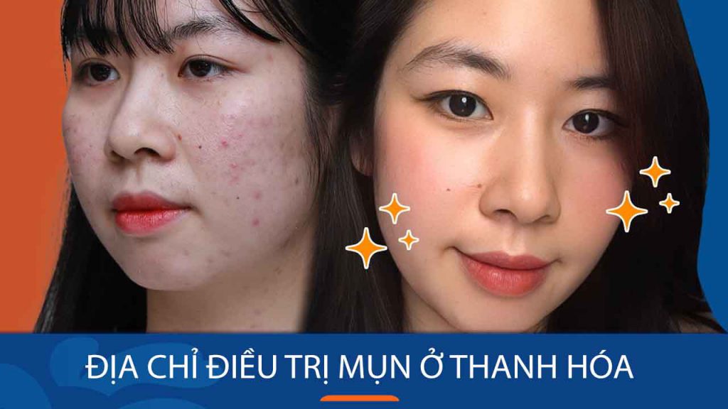 Địa chỉ trị mụn ở Thanh Hóa uy tín và đáng tin cậy nhất