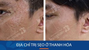 Địa chỉ trị sẹo ở Thanh Hóa tốt nhất hiện nay? Review chi tiết