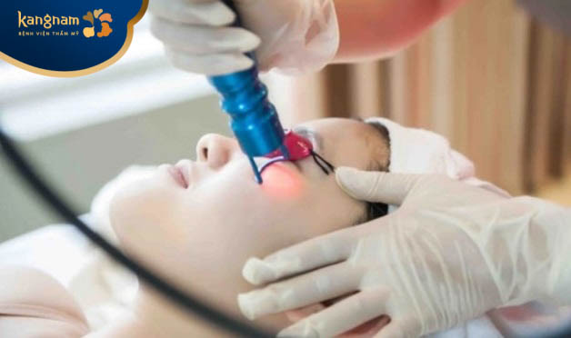 Laser Toning trị tàn nhang