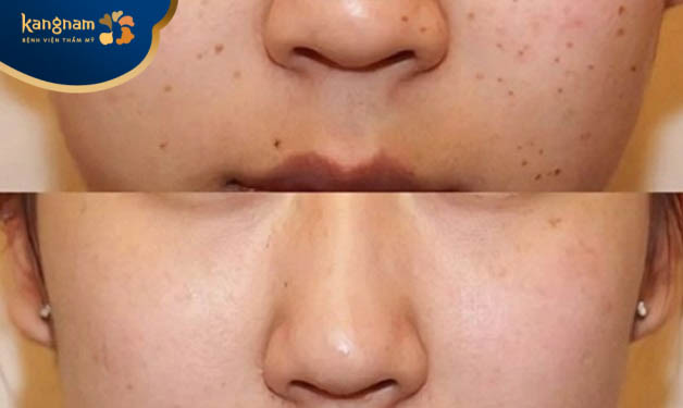 Bạn Thùy Linh chia sẻ sau trị tàn nhang tại Kangnam