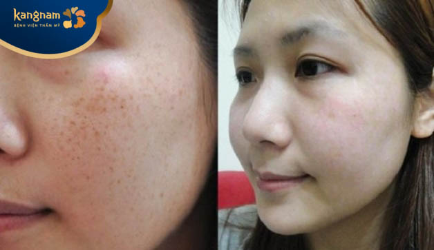 Bạn Thu Lan chia sẻ với điều dưỡng của Kangnam sau trị tàn nhang