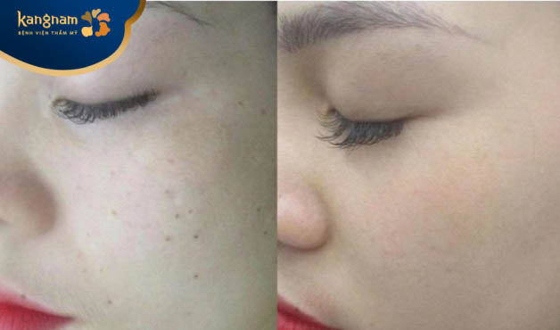 Bạn Thúy Hiền gửi feedback sau trị tàn nhang