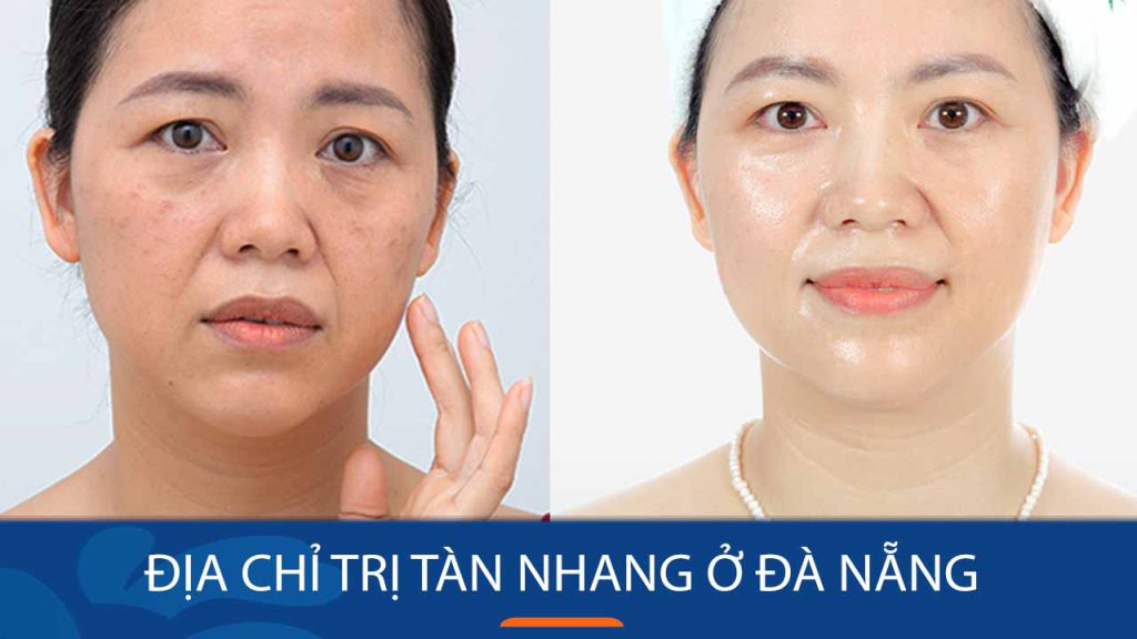 Địa chỉ chữa nám, tàn nhang uy tín nhất Đà Nẵng