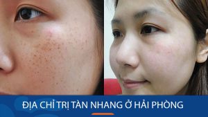 Địa chỉ trị tàn nhang ở Hải Phòng Uy tín, An toàn và triệt để