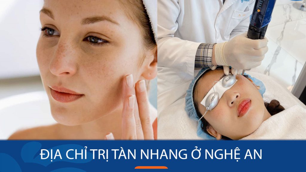Địa chỉ trị tàn nhang ở Nghệ An loại sạch đốm nâu triệt để