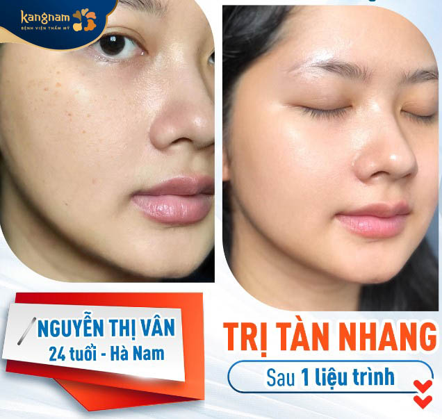 Làn da mịn màng, đều màu sau trị tàn nhang tại Kangnam