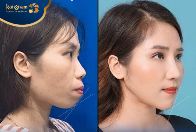 Ứng dụng công nghệ và kỹ thuật tân tiến mang lại kết quả thẩm mỹ ưng ý cho khách hàng