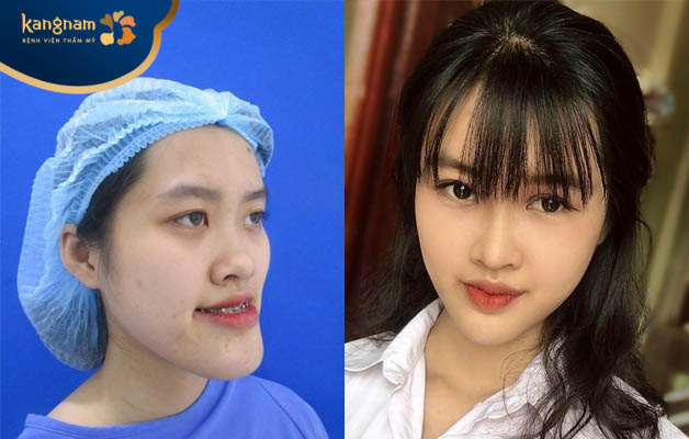 Mai Anh trước và sau trượt cằm