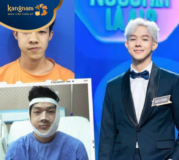 Minh Hoàng tự tin sau trượt cằm tại Kangnam