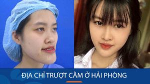 Trượt cằm kangnam Hải Phòng