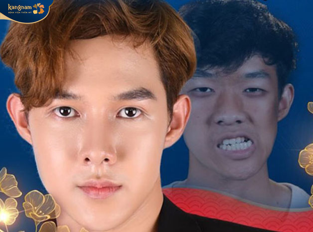 Phần hàm cân đối không còn khuyết điểm sau phẫu thuật