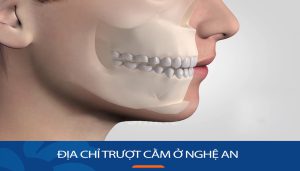 Trượt cằm kangnam Nghệ An