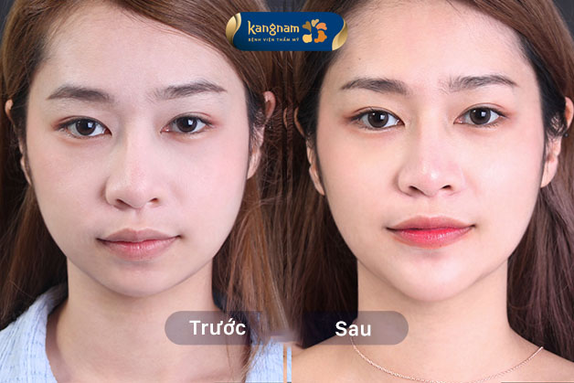 Khuôn mặt xinh đẹp chuẩn V-line sau trượt cằm