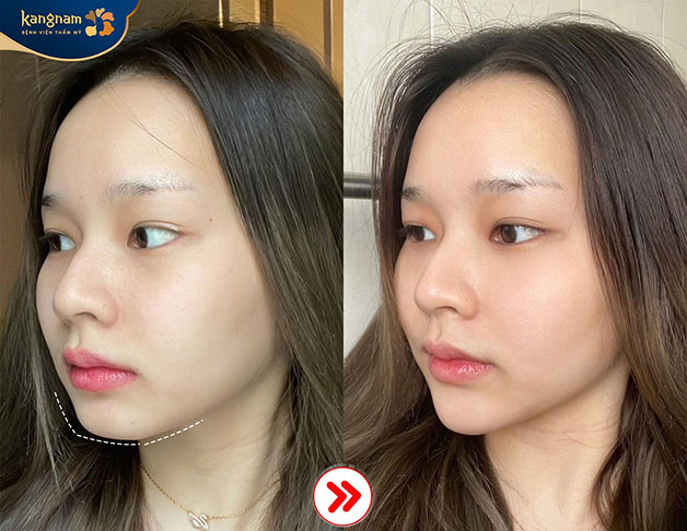 Sau trượt cằm, gương mặt sắc nét hơn