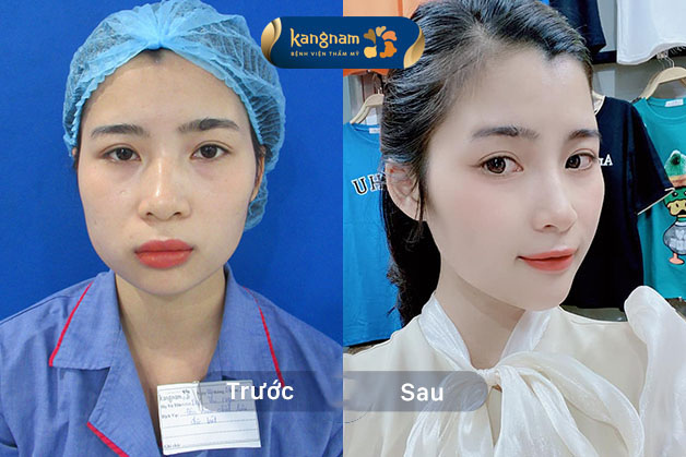 Khuyết điểm cằm lệch, không cân đối đã được khắc phục hoàn toàn