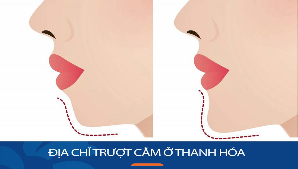 Trượt cằm Kangnam Thanh Hóa