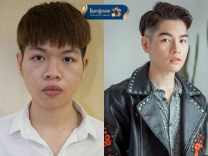 Đức Phúc phẫu thuật thẩm mỹ “lột xác” sau 5 tiếng