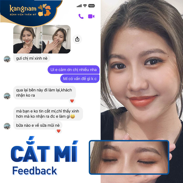 Mí xinh giúp chị khách thêm tự tin, có động lực sửa thêm dáng mũi cho hoàn hảo