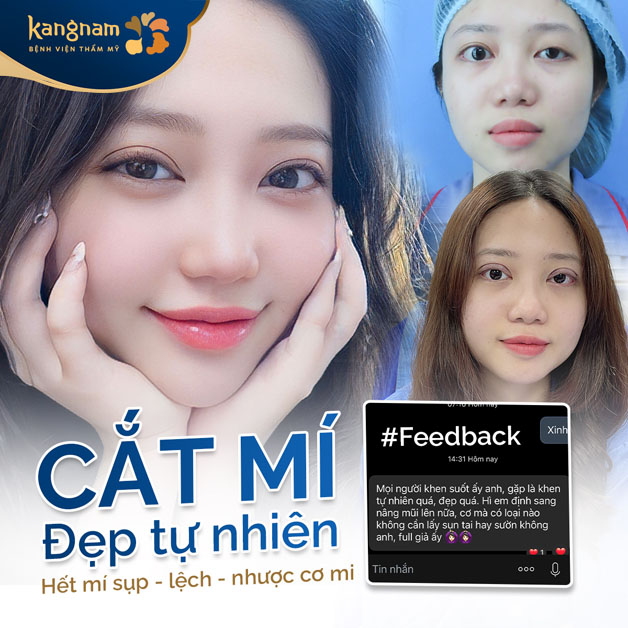 Mí mắt đẹp tự nhiên, hết sụp mí, hết nhược cơ mi, 100% khách hàng ưng ý