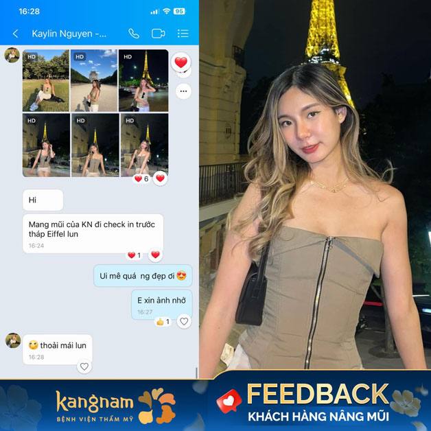 Khách hàng Việt kiều về Kangnam thẩm mỹ với mong muốn tiết kiệm chi phí, mũi nhanh hồi phục