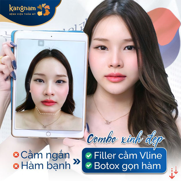 Quy trình tiêm filler an toàn, cho ra kết quả tự nhiên