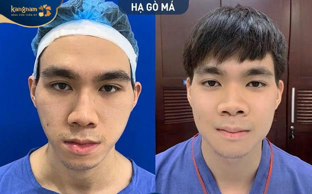 Khách hàng lột xác hoàn toàn sau khi hạ gò má