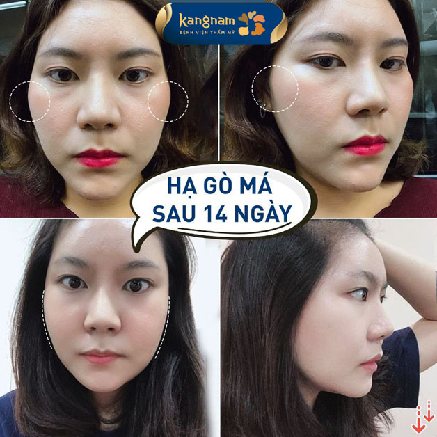 Khuôn mặt của khách hàng sau khi hạ gò má 14 ngày