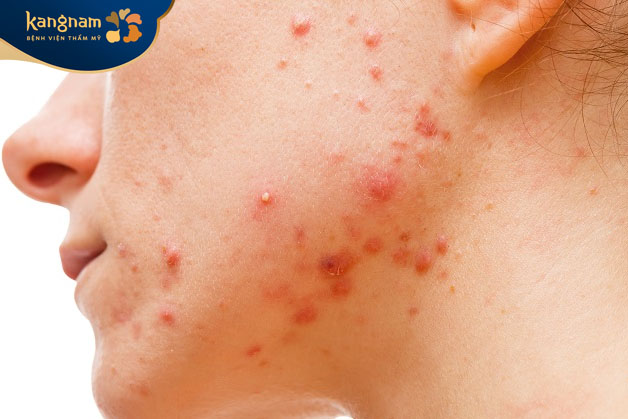 Mụn mủ sưng viêm ở quai hàm