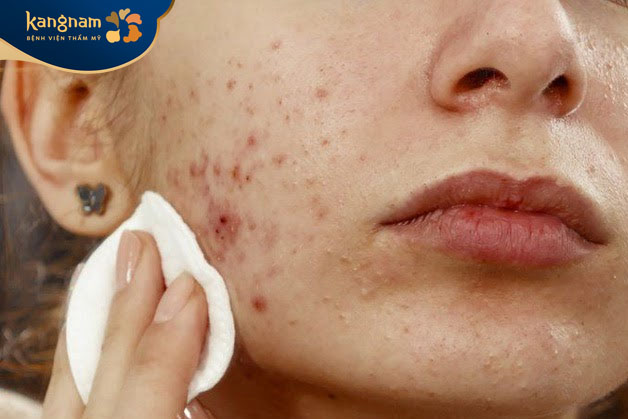 Tình trạng mụn và thâm nặng nề