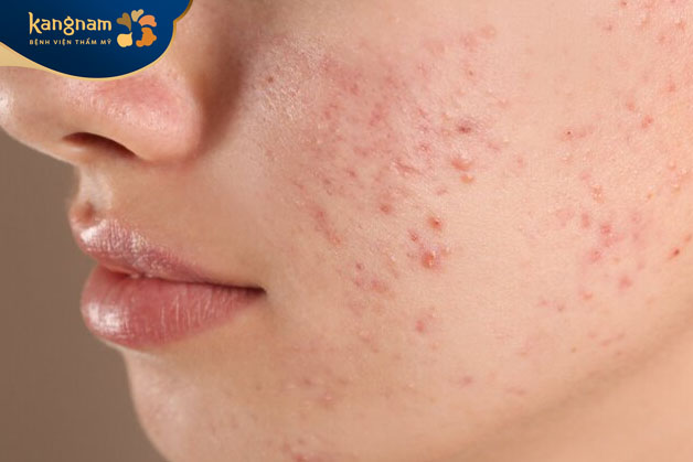 Mụn sần sùi, mụn ẩn và mụn viêm ở má