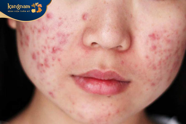 Mụn mủ xuất hiện nhiều vùng má thường là kết quả của sự tắc nghẽn lỗ chân lông
