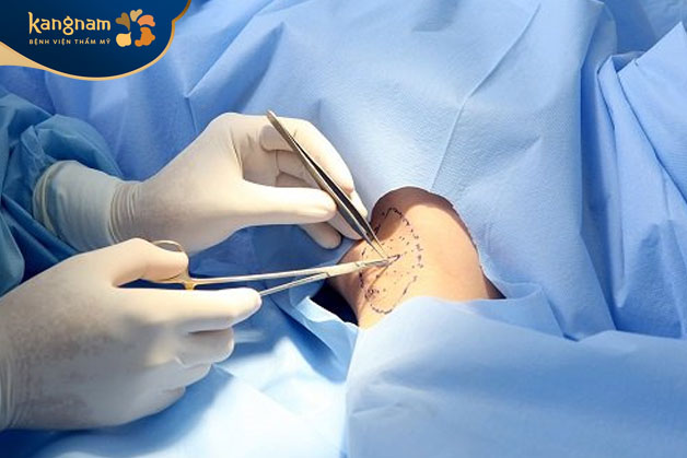 Công nghệ hút tuyến Endo Dry hiện đại