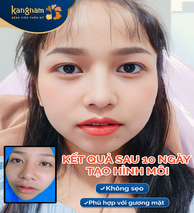 Tạo hình môi tim