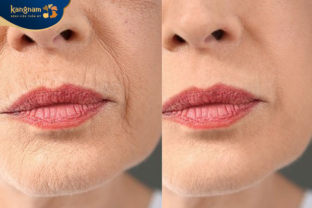 Khách hàng xóa nhăn nhờ Meso