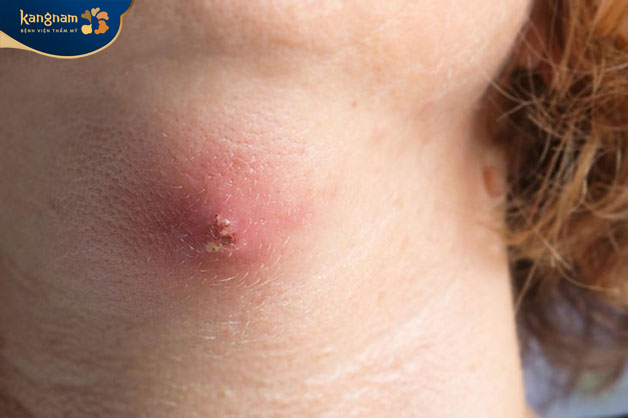 Mụn ở cổ có nếu xưng bất thường là dấu hiệu của bệnh lý tiềm ẩn